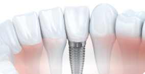Implant Dentistry